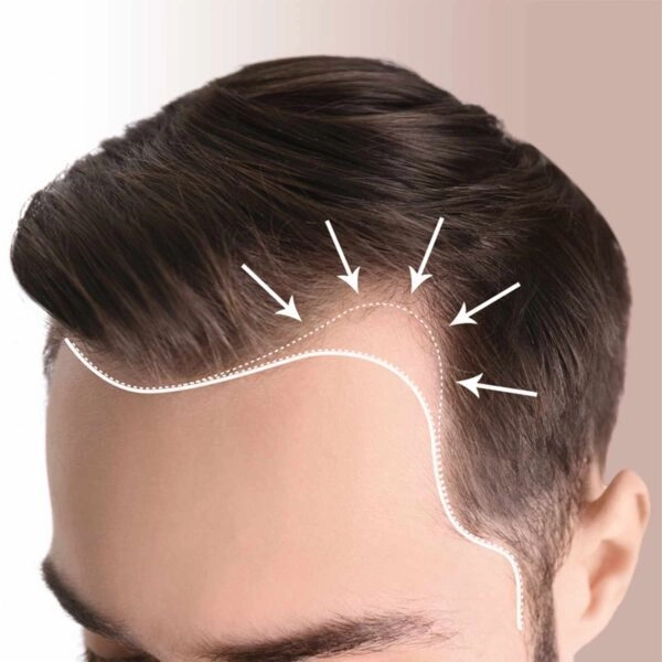 hair transplant before-https://krishamedspa.in/fut-hair-transplant-in-vadodara/