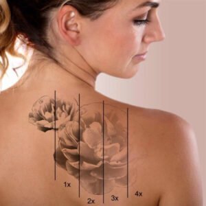 laser tattoo removal treatmaent-https://krishamedspa.in/laser-tattoo-removal-in-vadodara/