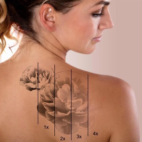 laser tattoo removal treatmaent-https://krishamedspa.in/laser-tattoo-removal-in-vadodara/