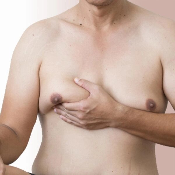 male breast reduction before-https://krishamedspa.in/male-breast-reduction-surgery-in-vadodara/