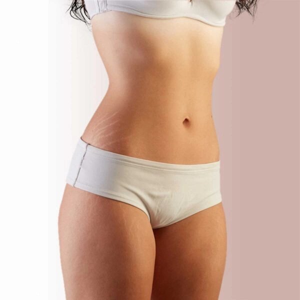 Stretch Mark Reduction treatment-https://krishamedspa.in/stretch-mark-reduction-treatment-in-vadodara/