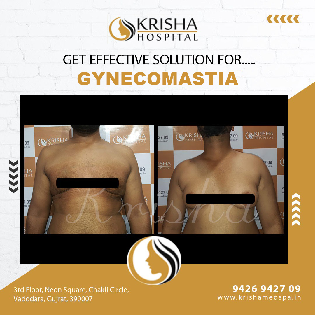 Gynecomastia surgery before/after-https://krishamedspa.in/male-breast-reduction-surgery-in-vadodara/