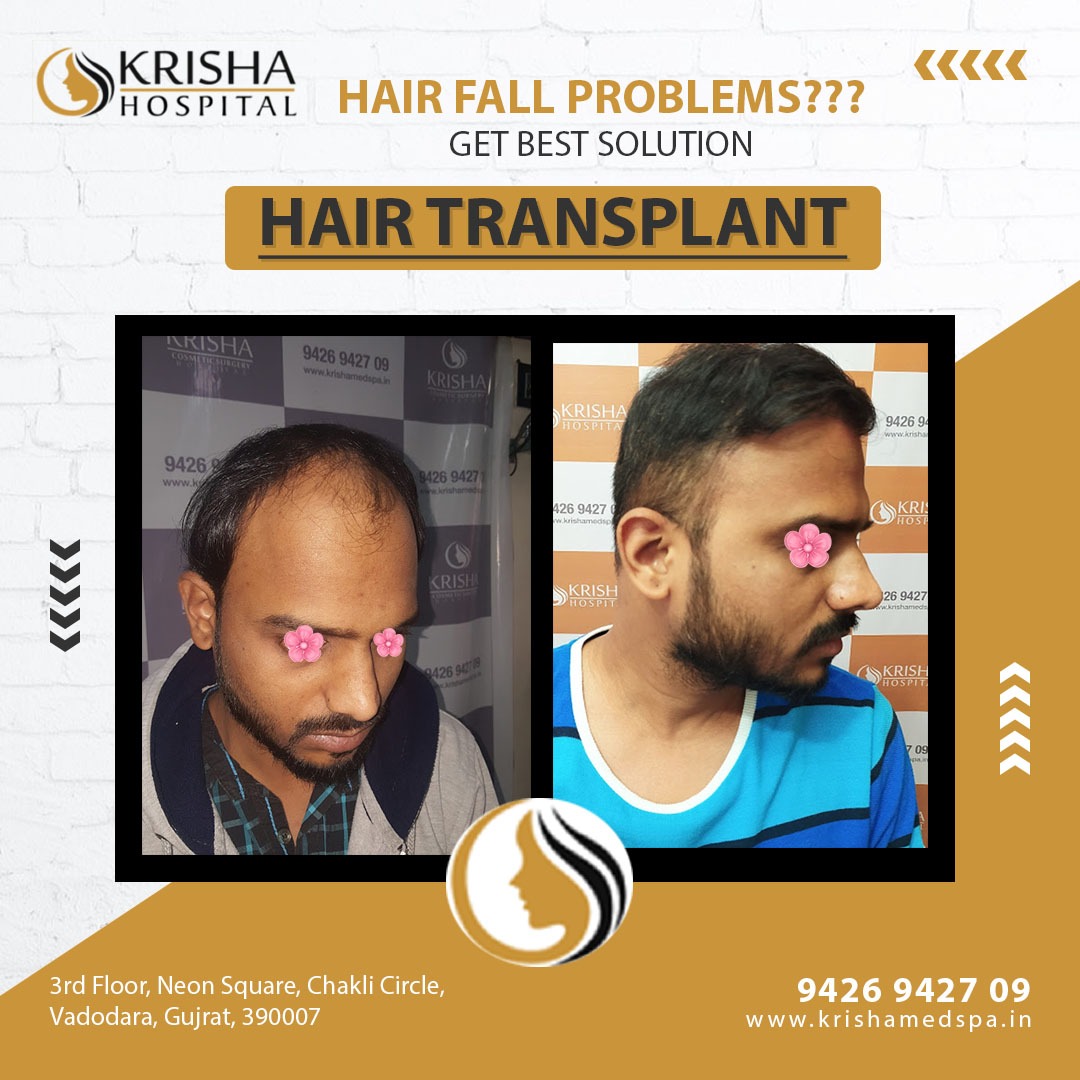 hair transplant before/after-https://krishamedspa.in/fue-hair-transplant-in-vadodara/