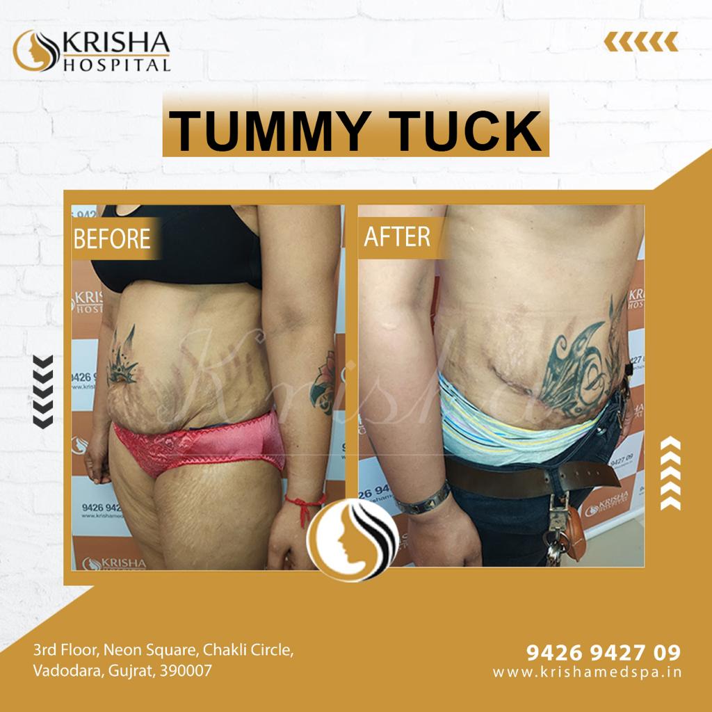 Tummy tuck surgery- before/after-https://krishamedspa.in/tummy-tuck-surgery-in-vadodara/