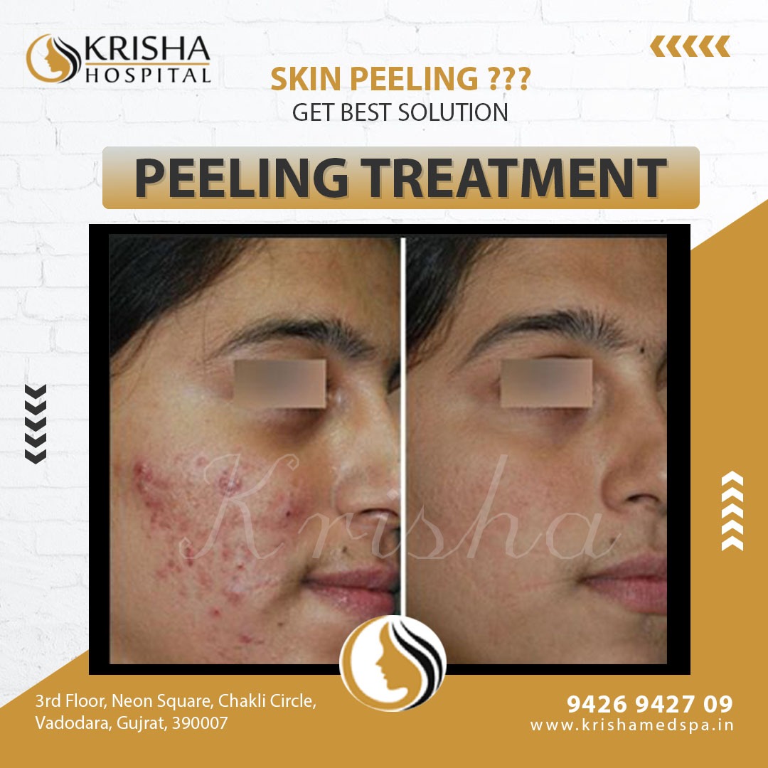 peeling treatment before/after-https://krishamedspa.in/anti-ageing-wrinkle-treatment-in-vadodara/