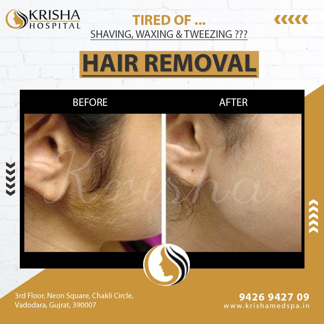 laser hair removal before/after-https://krishamedspa.in/laser-hair-removal-treatment-in-vadodara/