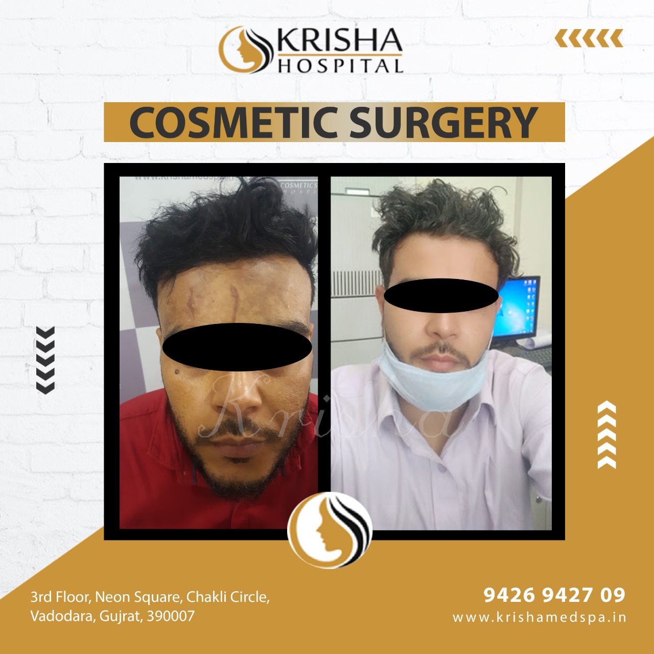 Mole removal before/after-https://krishamedspa.in/mole-wart-tag-removal-treatment-in-vadodara/