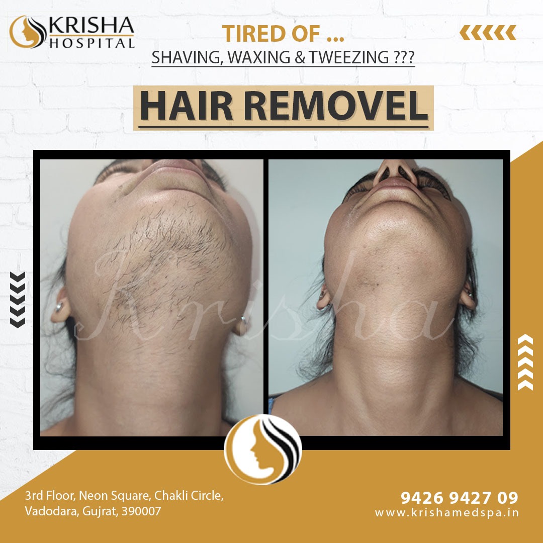 laser hair removal before/after-https://krishamedspa.in/laser-hair-removal-treatment-in-vadodara/