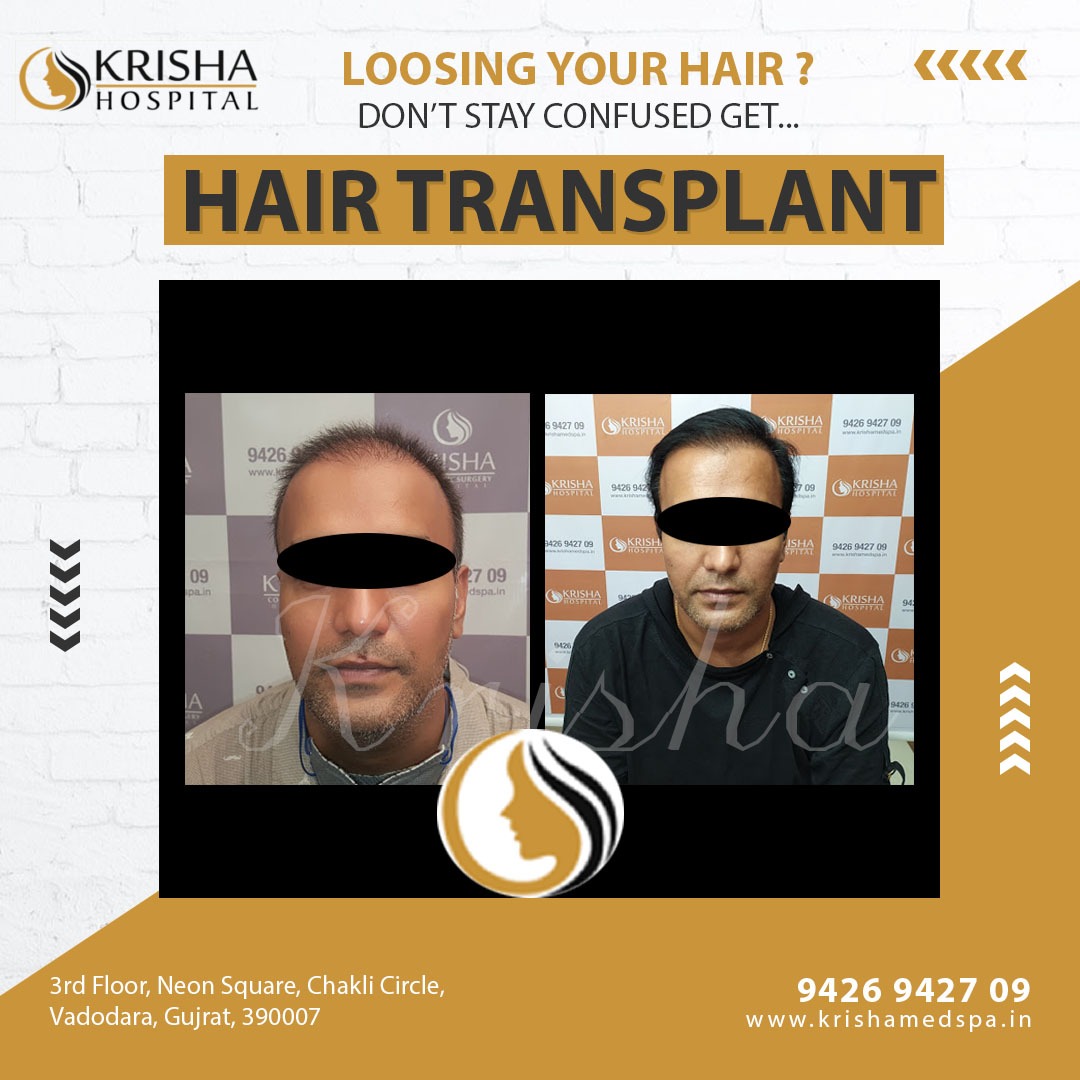 hair transplant before/after-https://krishamedspa.in/fue-hair-transplant-in-vadodara/