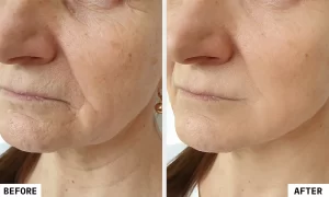Anti-Ageing-wrinkle