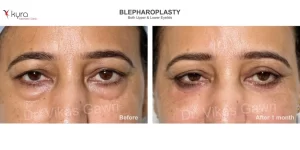 BLEPHAROPLASTY