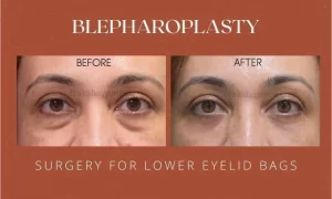 BLEPHAROPLASTY(1)
