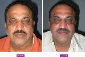 Botox(2)