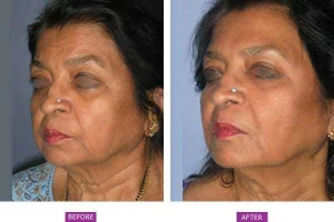 Botox(4)