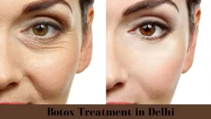 Botox(5)