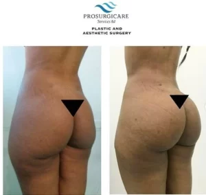 Brazillian Butt Lift(1)