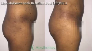 Brazillian Butt Lift(2)