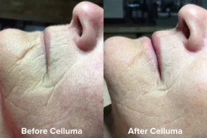 anti-ageing- wrinkle