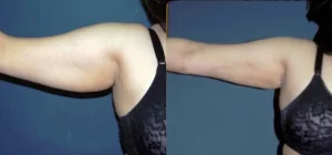 arm lift (1)