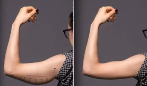 arm lift (2)