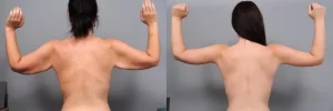 arm lift (3)