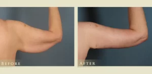 arm lift (4)