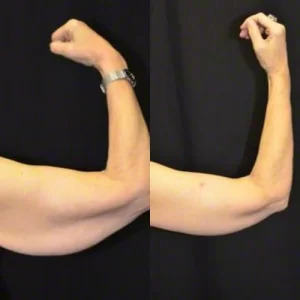 arm lift (5)