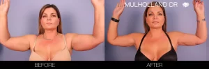 arm lift (6)