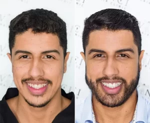 beard hair transplant