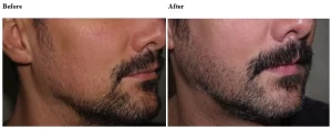 beard hair transplant(1)