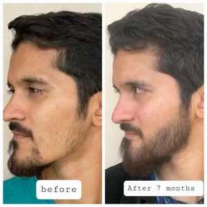 beard hair transplant(3)