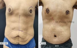 belt lipectomy