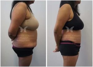 body lift