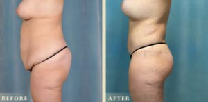 body lift_