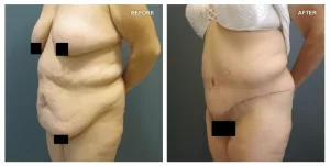 body lift_