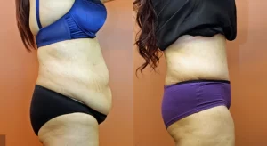 body lift_(1)
