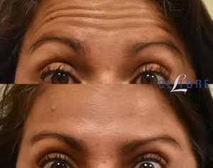 botox_