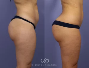 brazilian butt lift