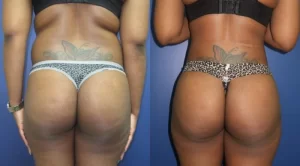 brazilian butt lift(1)