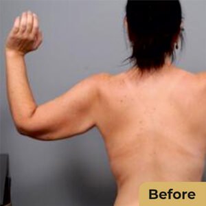 Arm Lift 01