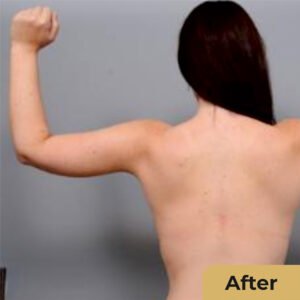 Arm Lift 02