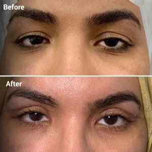 BROW LIFT1