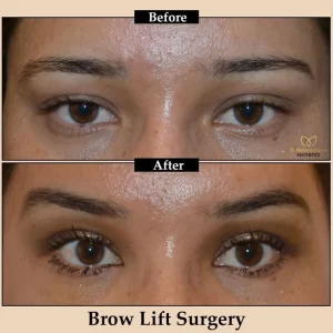 BROW LIFT2