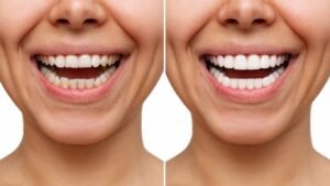 Before-and-after-shots