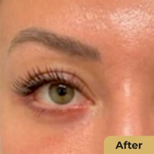 Blepharoplasty 01