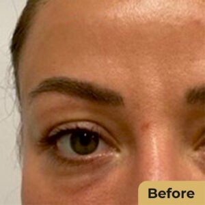 Blepharoplasty 02