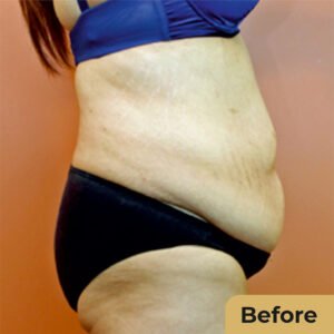 Body Lift 01