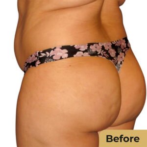 Brazillian butt lift 01