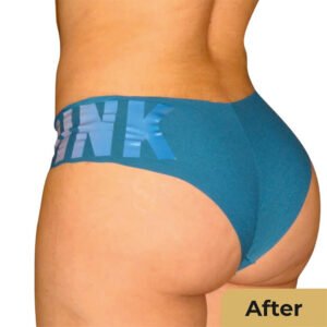 Brazillian butt lift 02