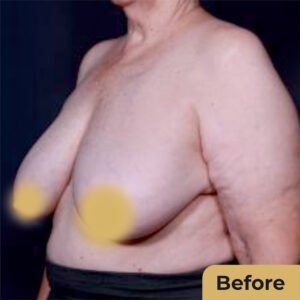 Breast Reduction 01